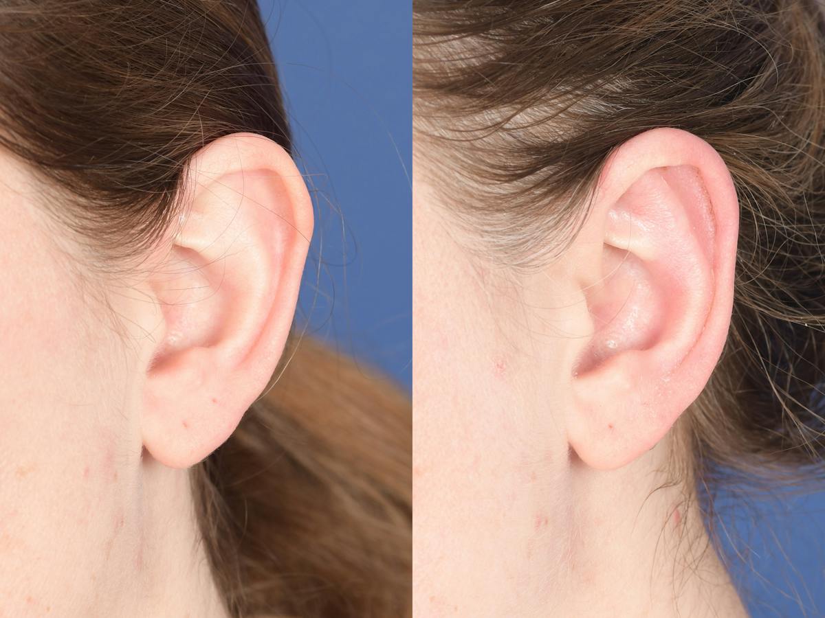 Otoplasty Before & After Gallery - Patient 396908 - Image 3