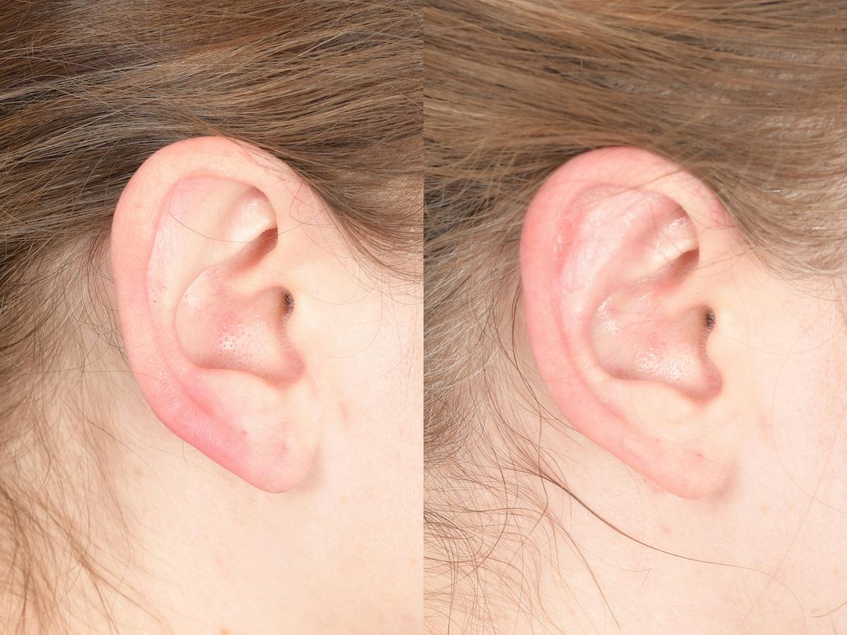 Otoplasty Before & After Gallery - Patient 396908 - Image 5