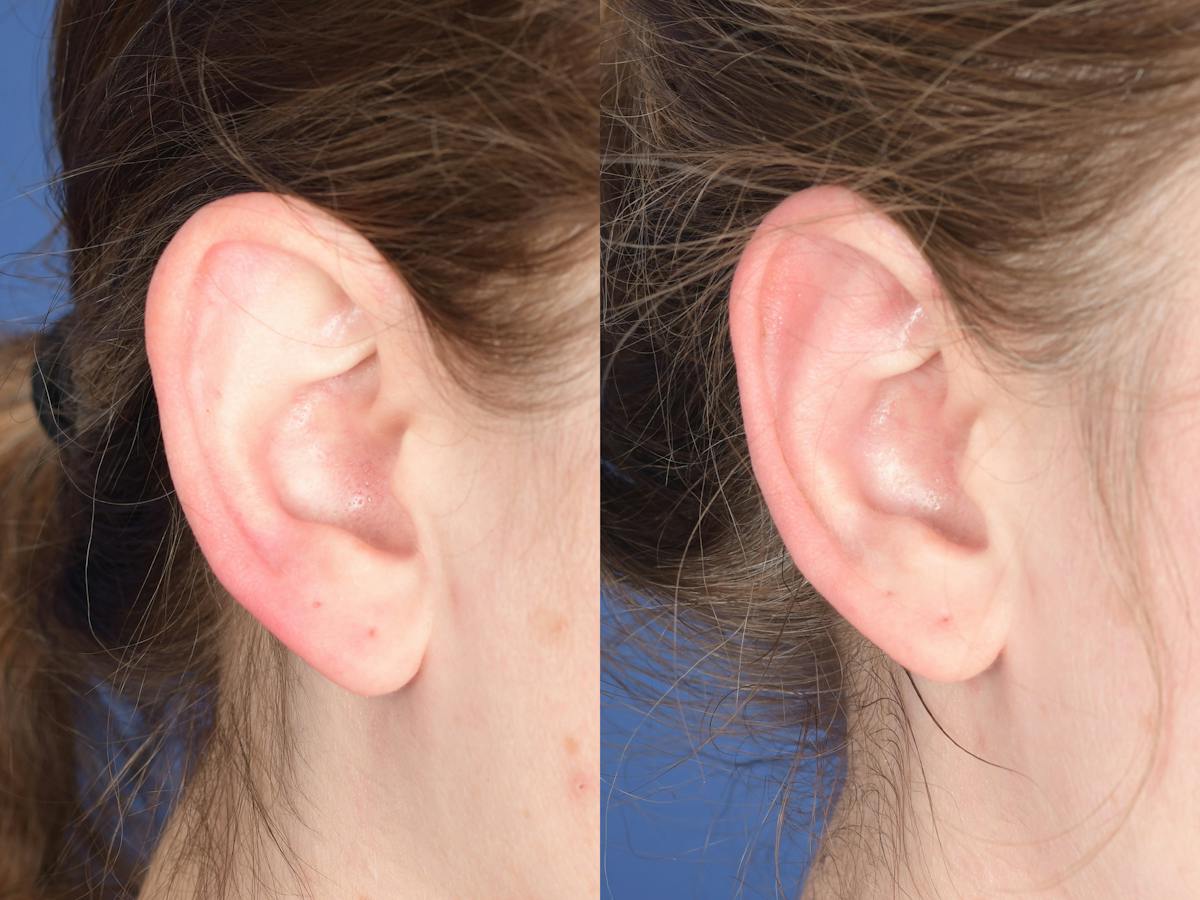 Otoplasty Before & After Gallery - Patient 396908 - Image 6