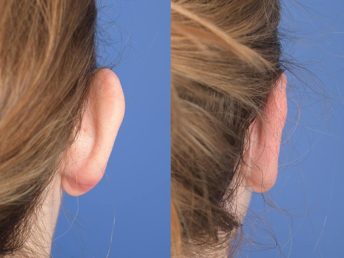 Otoplasty Before & After Gallery - Patient 396908 - Image 8