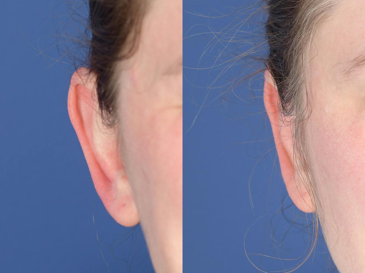 Otoplasty Before & After Gallery - Patient 396908 - Image 2