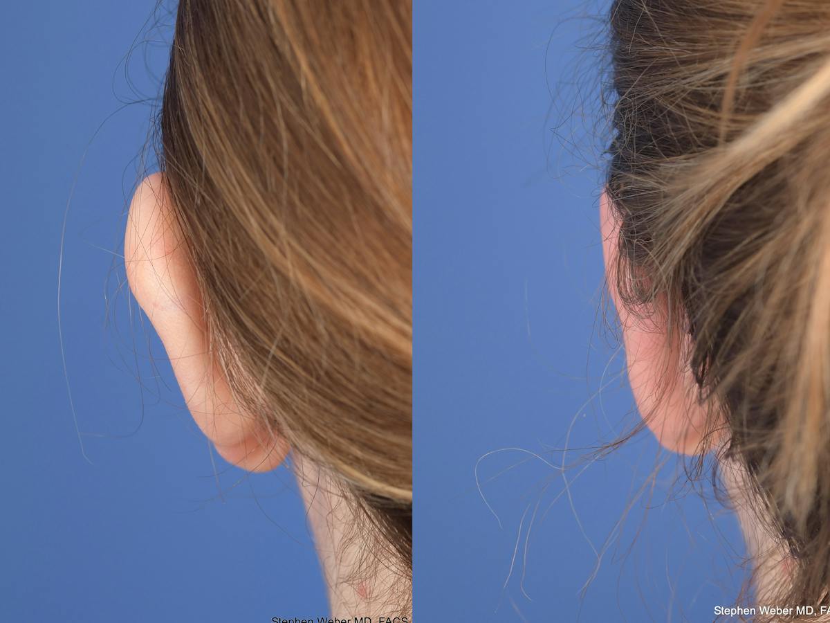Otoplasty Before & After Gallery - Patient 396908 - Image 7