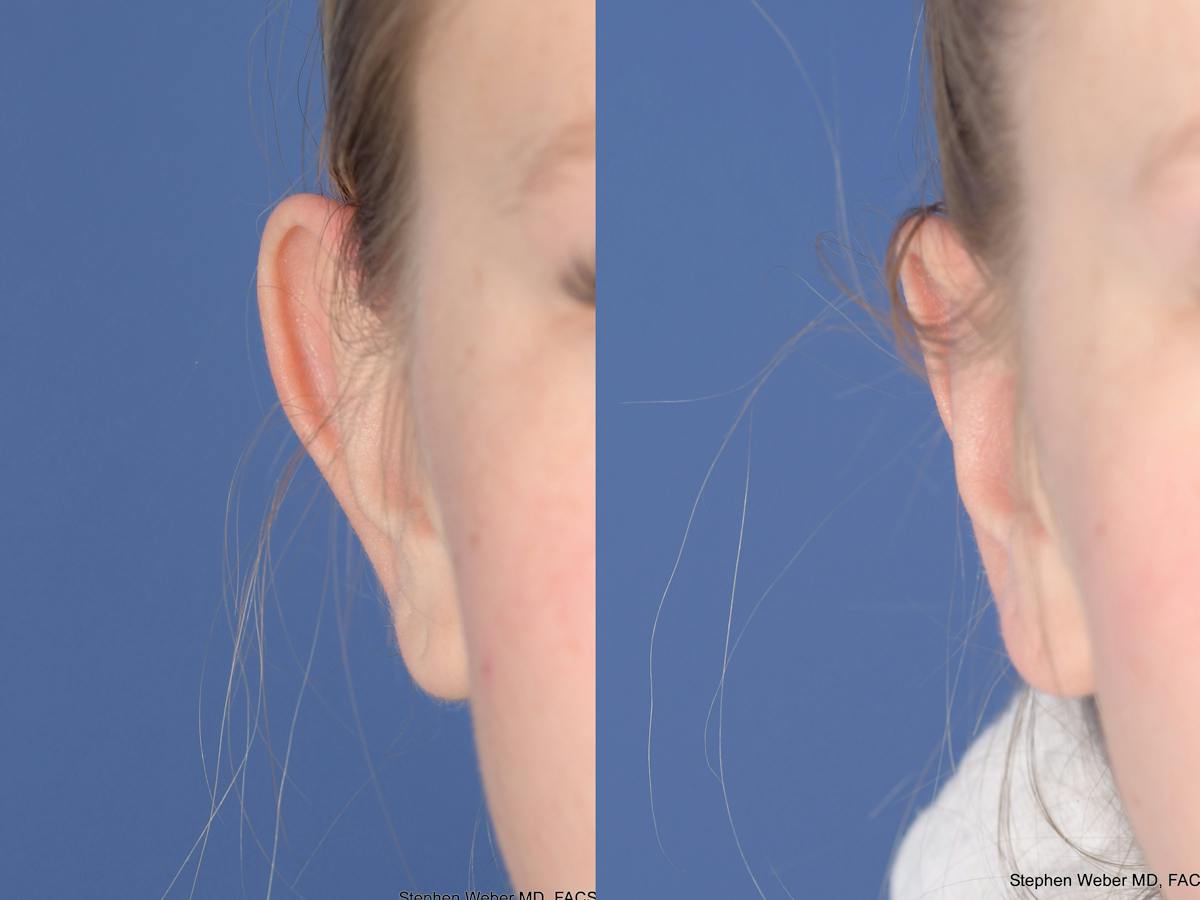 Otoplasty Before & After Gallery - Patient 220375 - Image 2