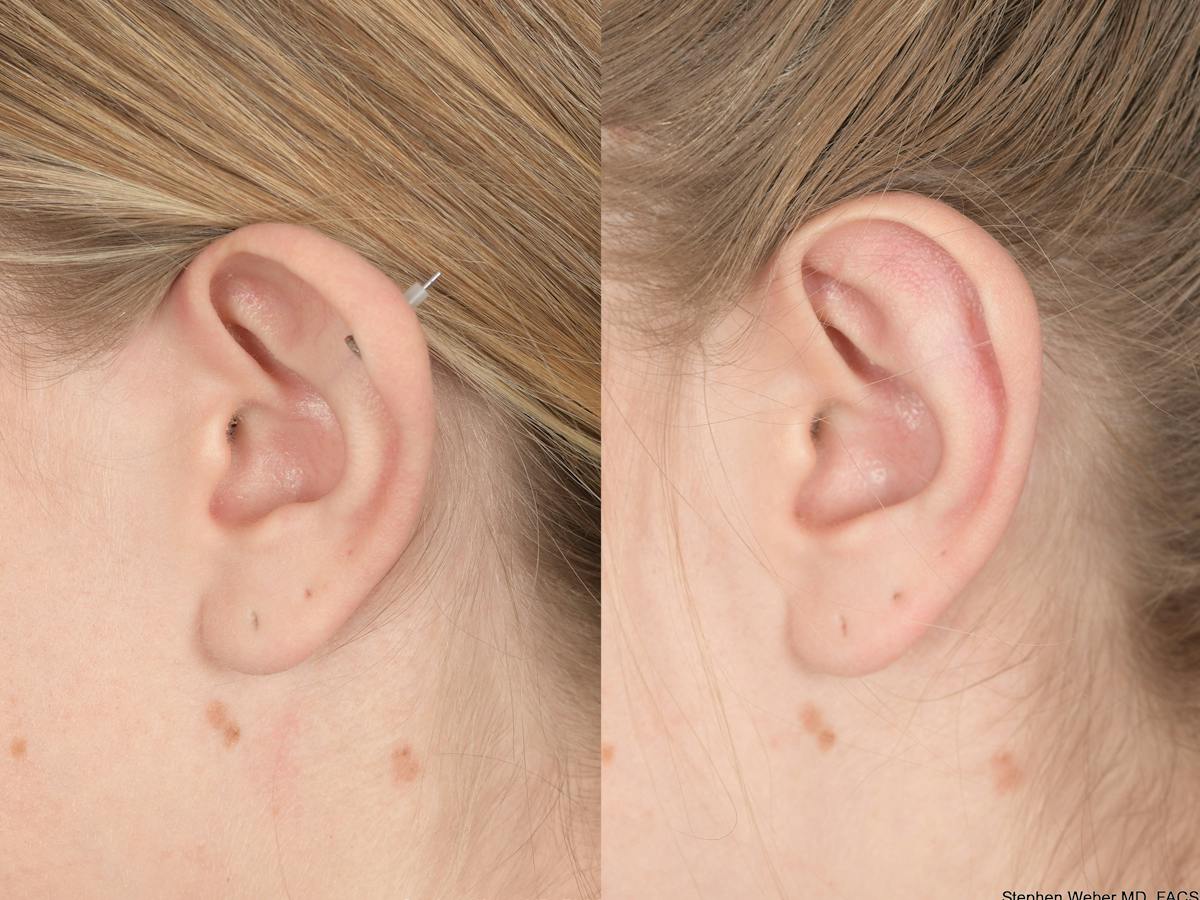 Otoplasty Before & After Gallery - Patient 220375 - Image 3
