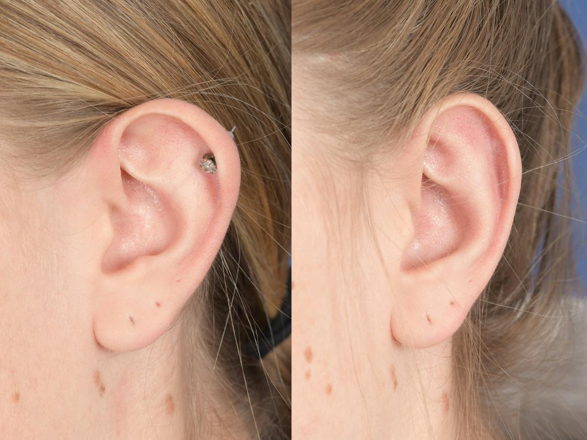 Otoplasty Before & After Gallery - Patient 220375 - Image 4
