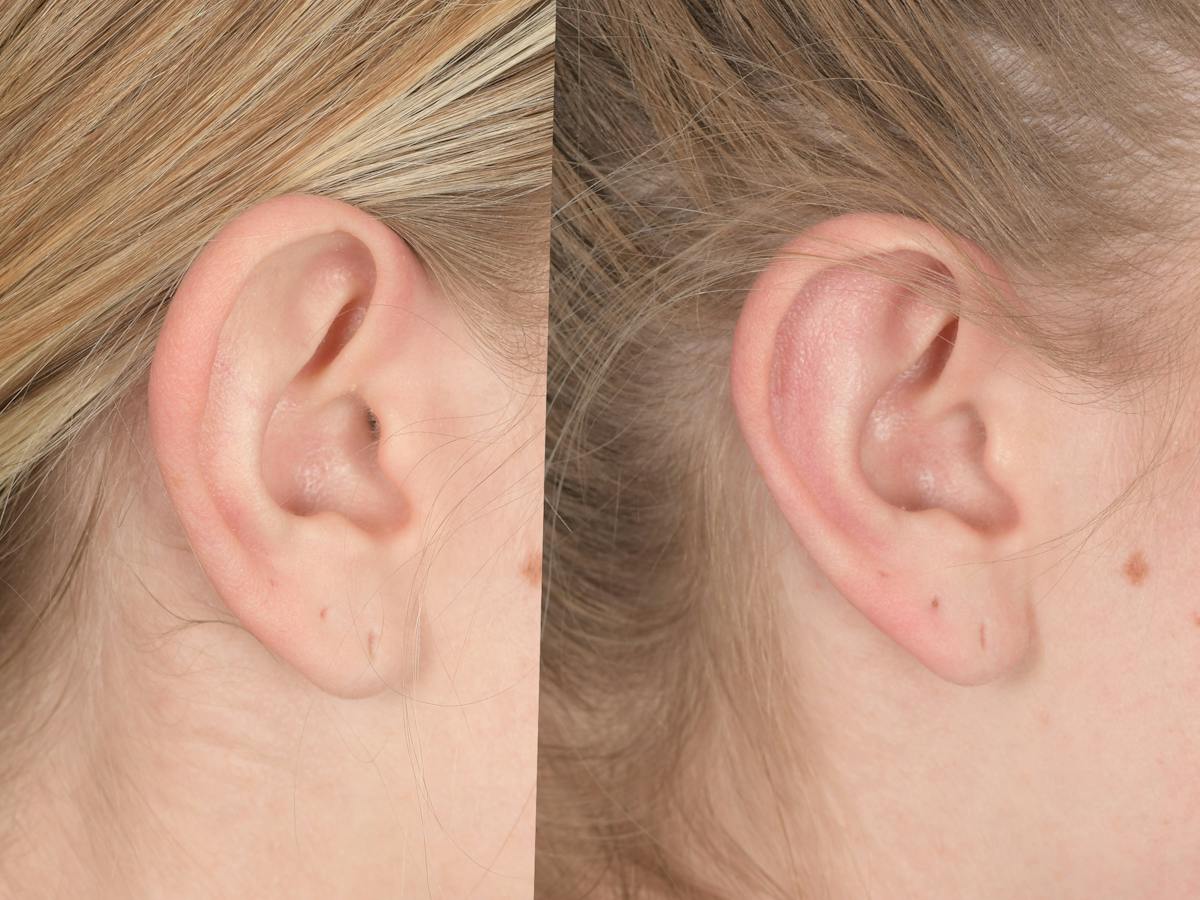 Otoplasty Before & After Gallery - Patient 220375 - Image 5