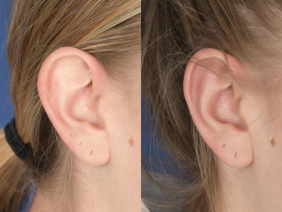 Otoplasty Before & After Gallery - Patient 220375 - Image 6