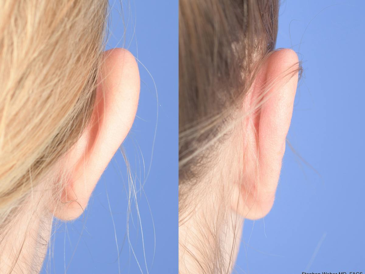 Otoplasty Before & After Gallery - Patient 220375 - Image 8