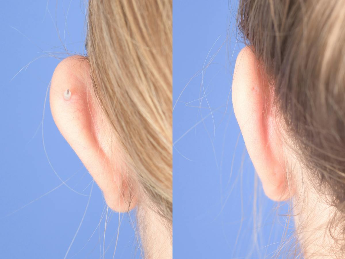 Otoplasty Before & After Gallery - Patient 220375 - Image 7