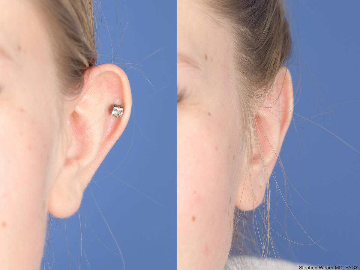 Otoplasty Before & After Gallery - Patient 220375 - Image 1