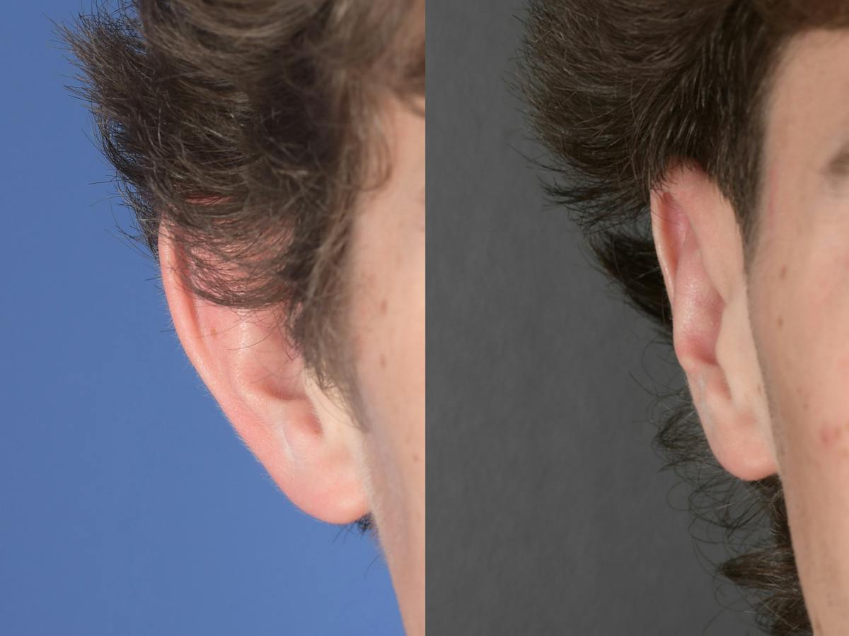 Otoplasty Before & After Gallery - Patient 850047 - Image 1