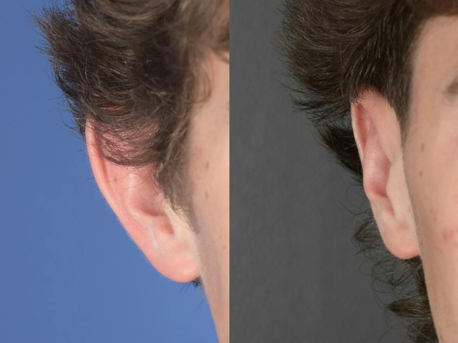 Otoplasty Before and After Photos
