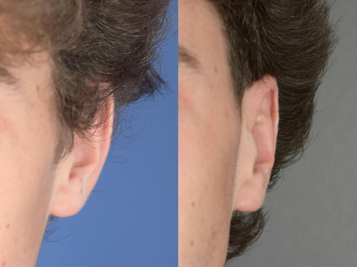 Otoplasty Before & After Gallery - Patient 850047 - Image 2