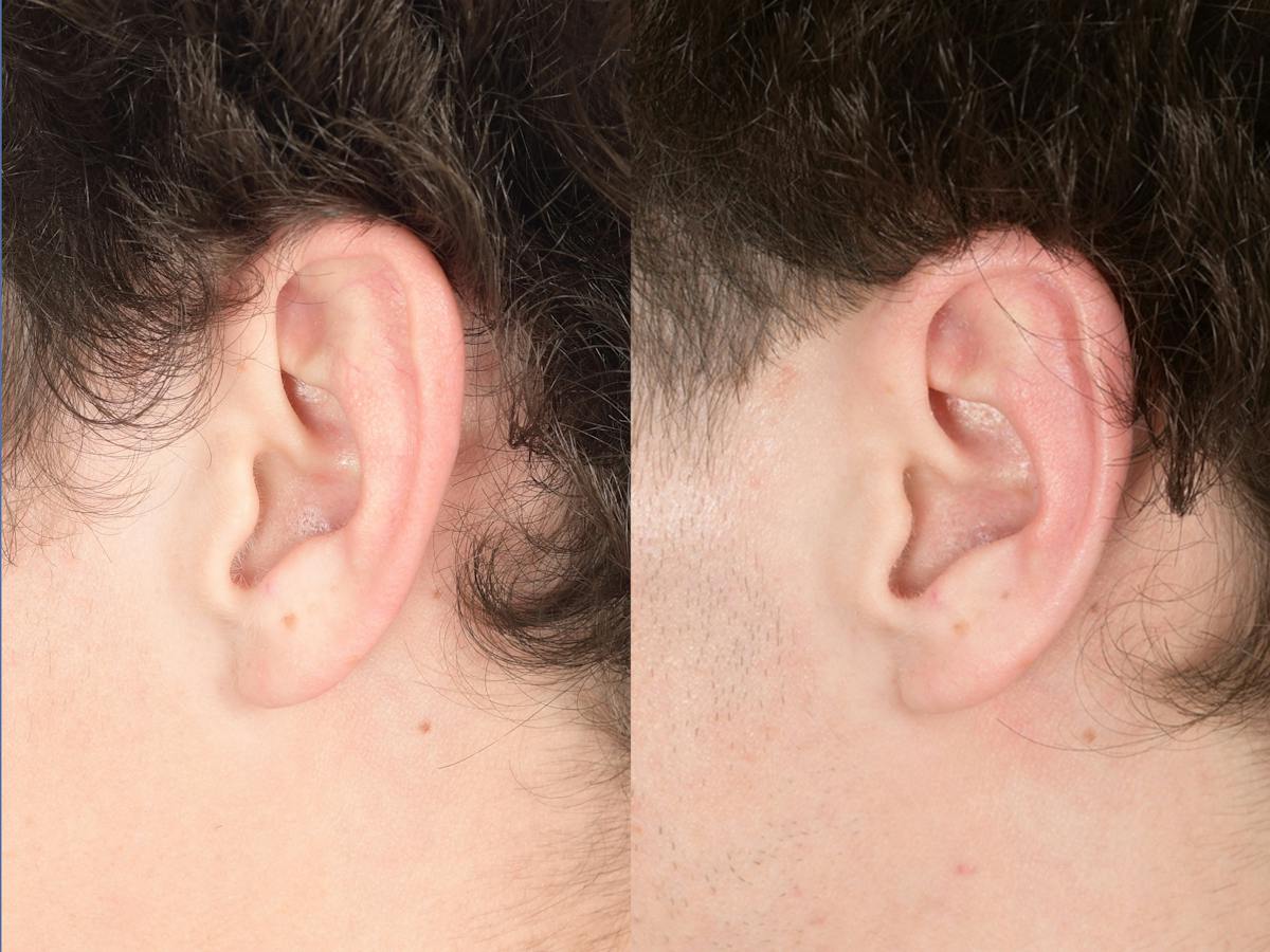 Otoplasty Before & After Gallery - Patient 850047 - Image 5