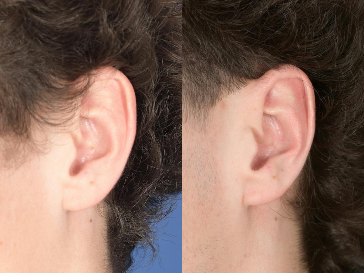 Otoplasty Before & After Gallery - Patient 850047 - Image 6