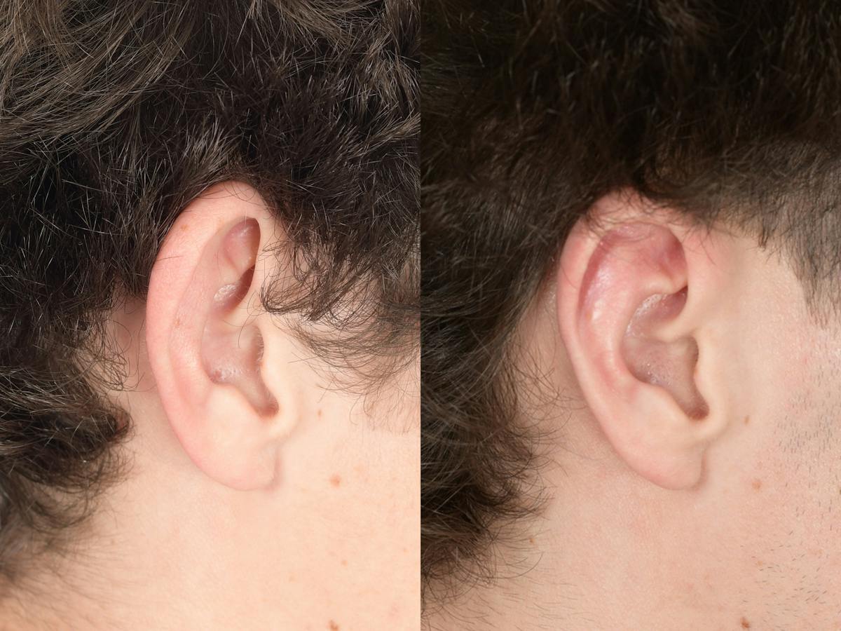 Otoplasty Before & After Gallery - Patient 850047 - Image 3