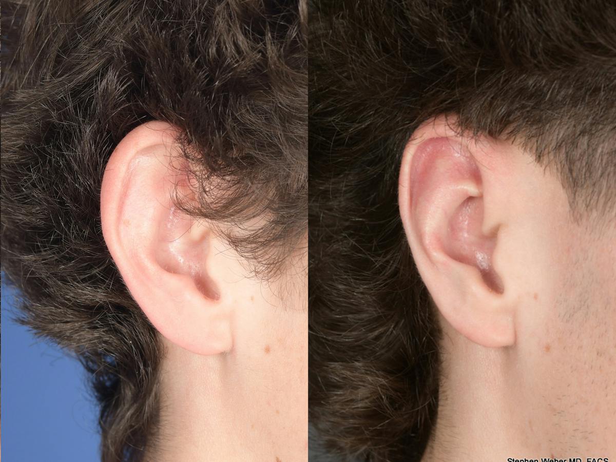 Otoplasty Before & After Gallery - Patient 850047 - Image 4