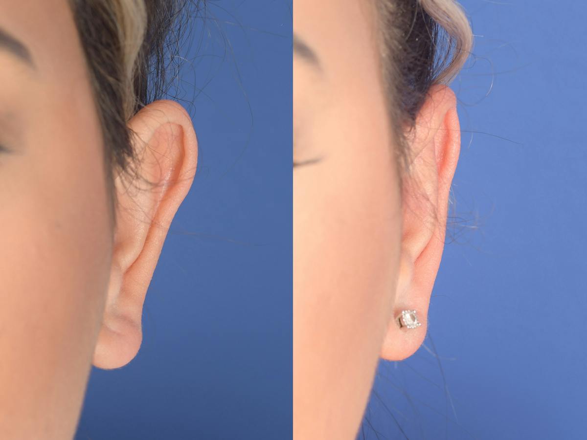 Otoplasty Before & After Gallery - Patient 180009 - Image 2