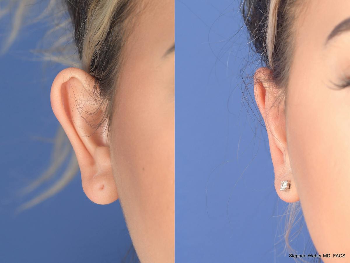 Otoplasty Before & After Gallery - Patient 180009 - Image 1