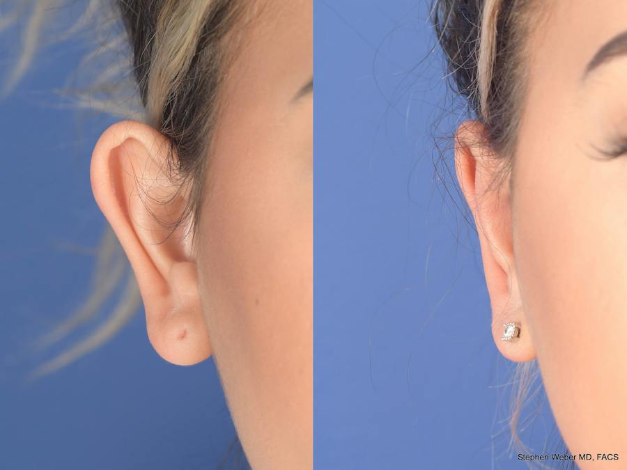 Otoplasty Before and After Photos