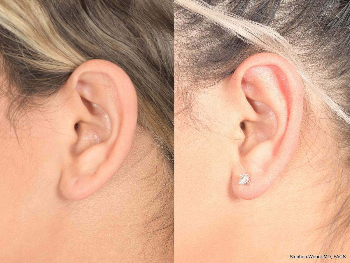 Otoplasty Before & After Gallery - Patient 180009 - Image 6