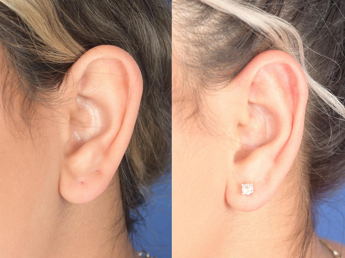 Otoplasty Before & After Gallery - Patient 180009 - Image 5