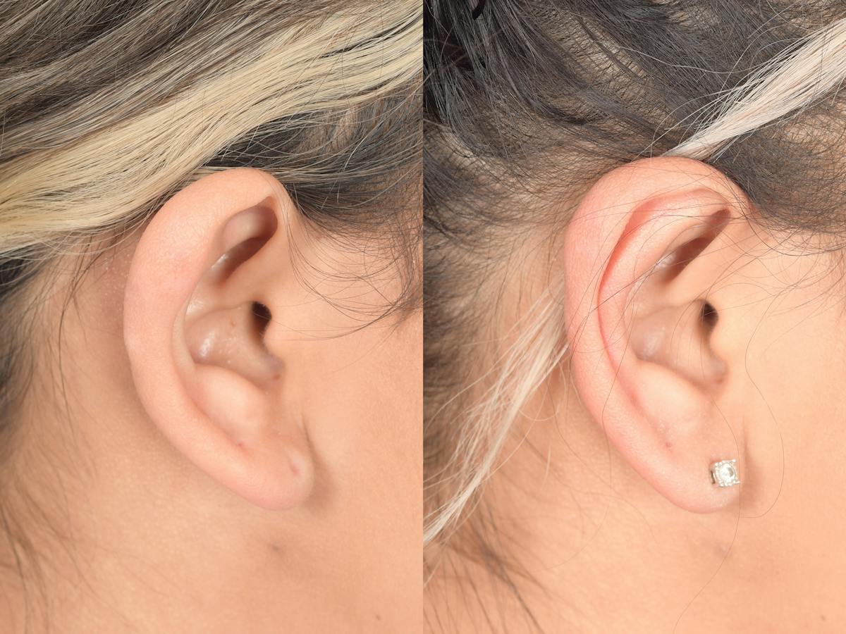 Otoplasty Before & After Gallery - Patient 180009 - Image 4