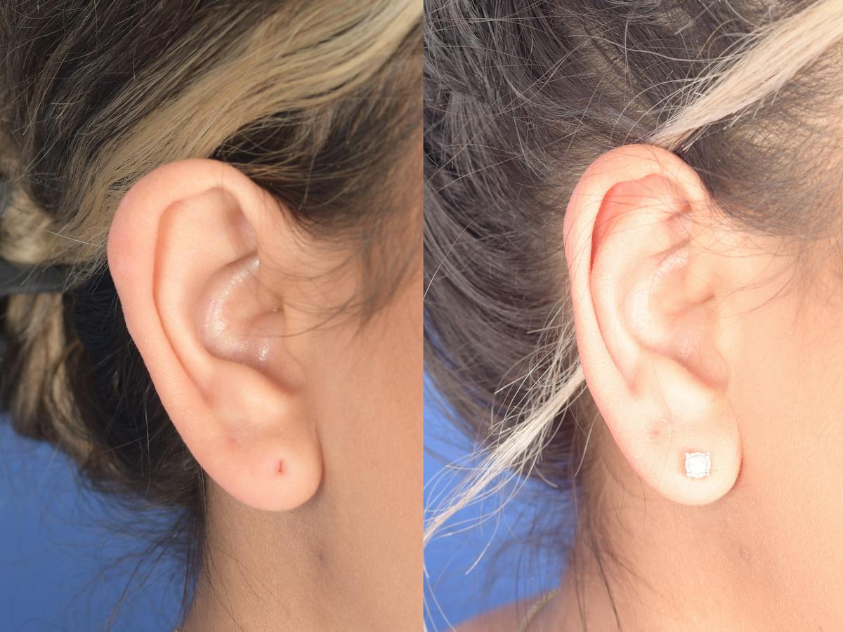 Otoplasty Before & After Gallery - Patient 180009 - Image 3