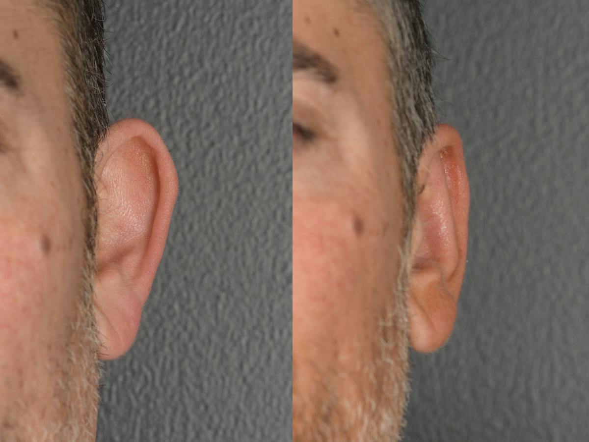 Otoplasty Before & After Gallery - Patient 290484 - Image 1