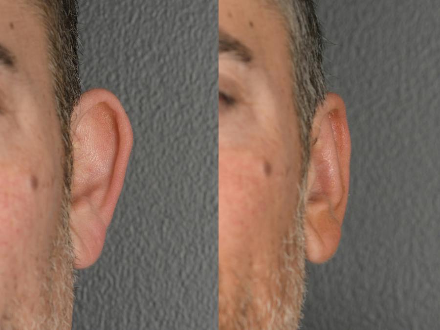 Otoplasty Before and After Photos