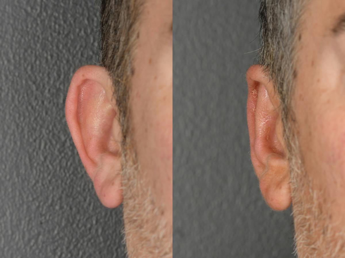 Otoplasty Before & After Gallery - Patient 290484 - Image 2