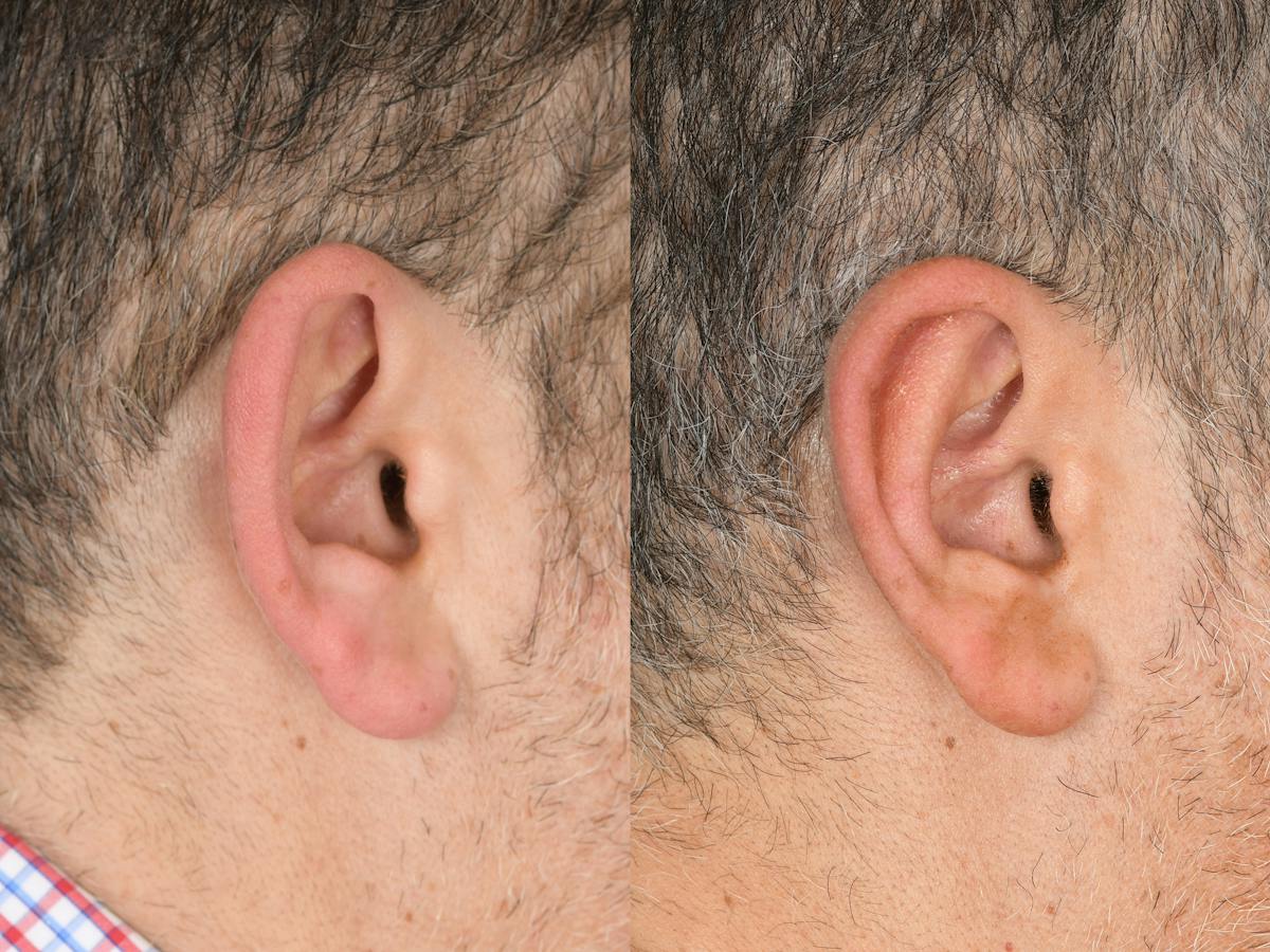Otoplasty Before & After Gallery - Patient 290484 - Image 3