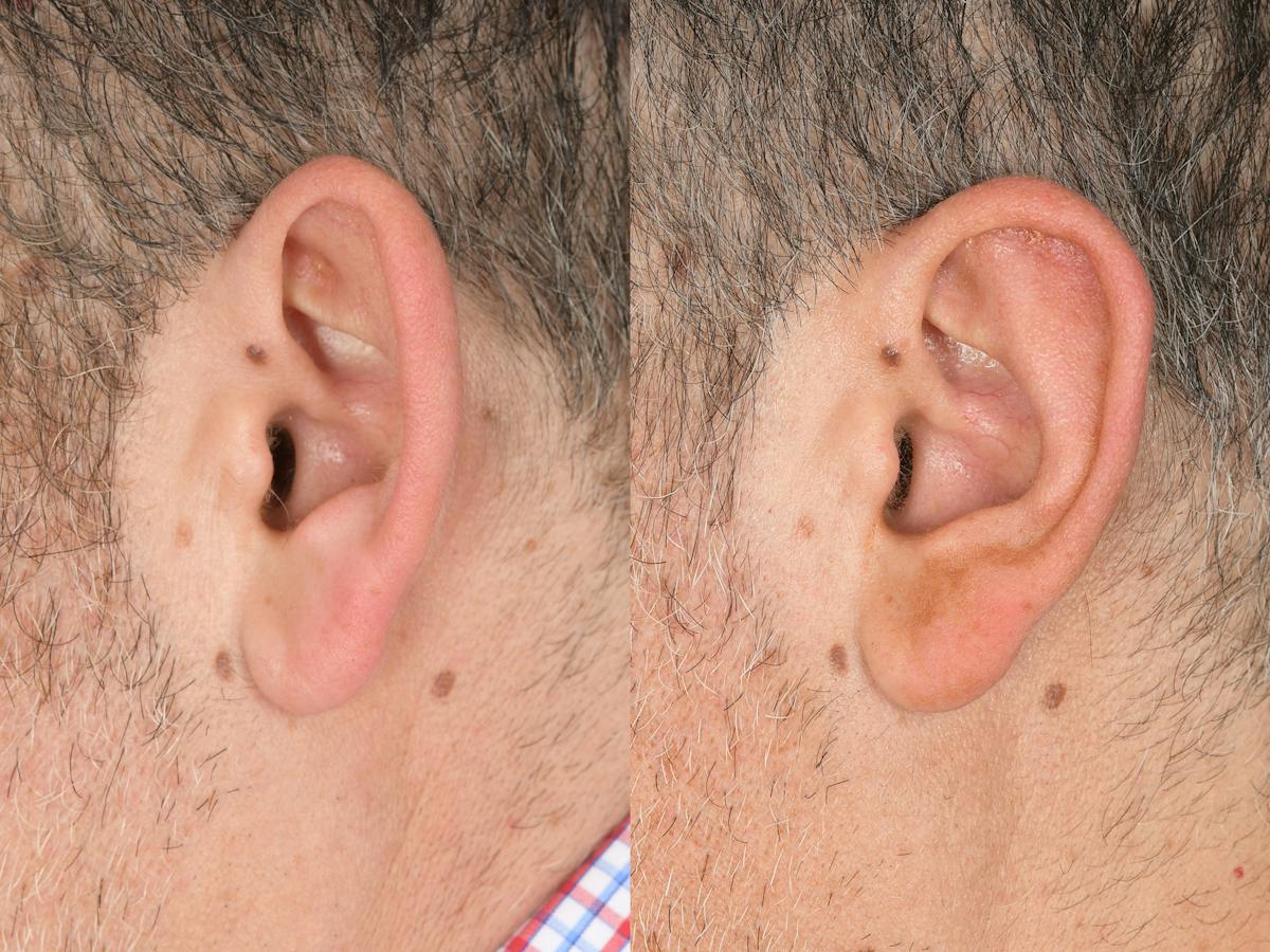 Otoplasty Before & After Gallery - Patient 290484 - Image 5