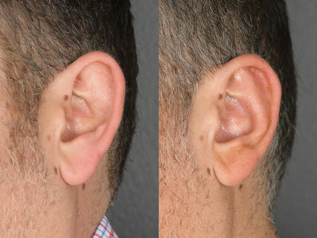 Otoplasty Before & After Gallery - Patient 290484 - Image 6