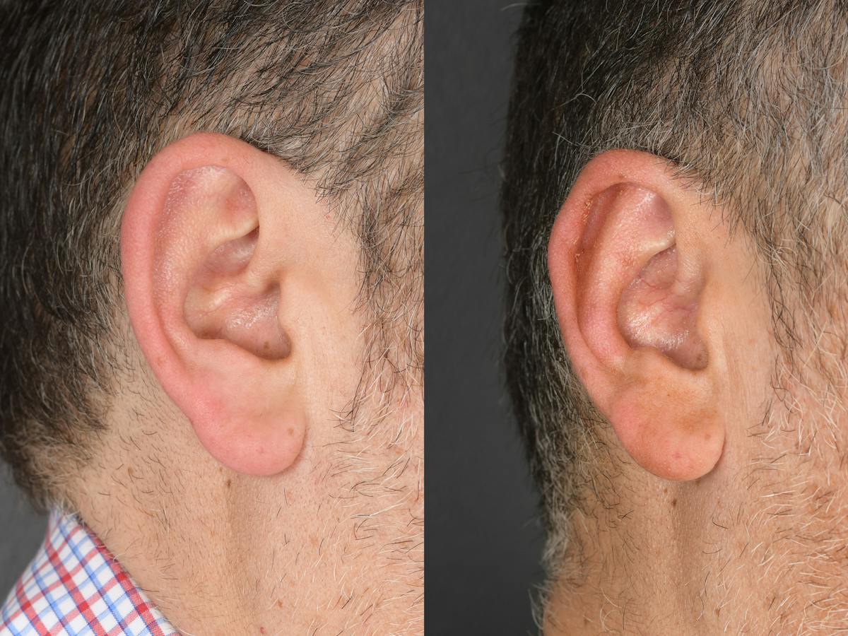 Otoplasty Before & After Gallery - Patient 290484 - Image 4
