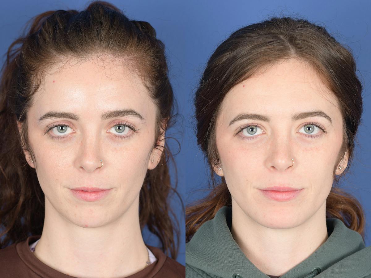 Chin Implant Before & After Gallery - Patient 399341 - Image 1