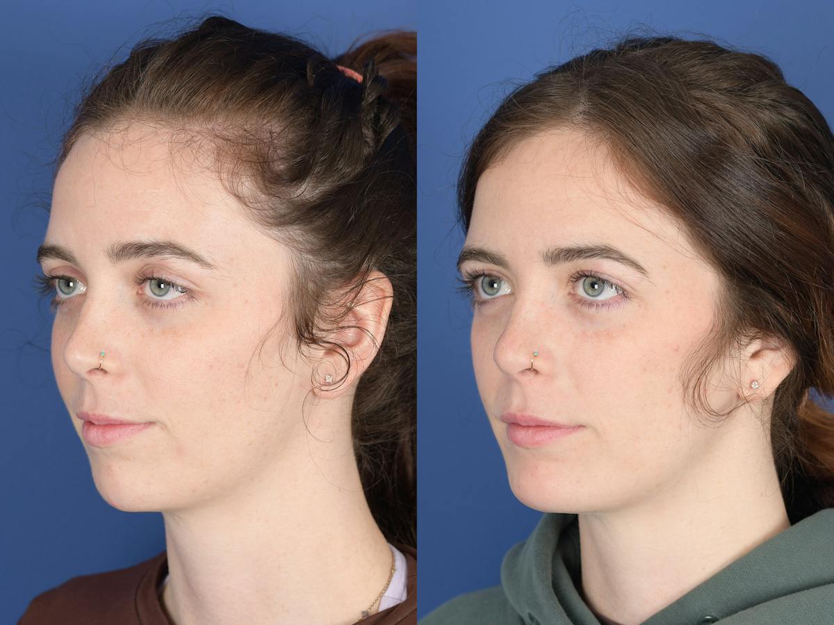 Chin Implant Before & After Gallery - Patient 399341 - Image 4