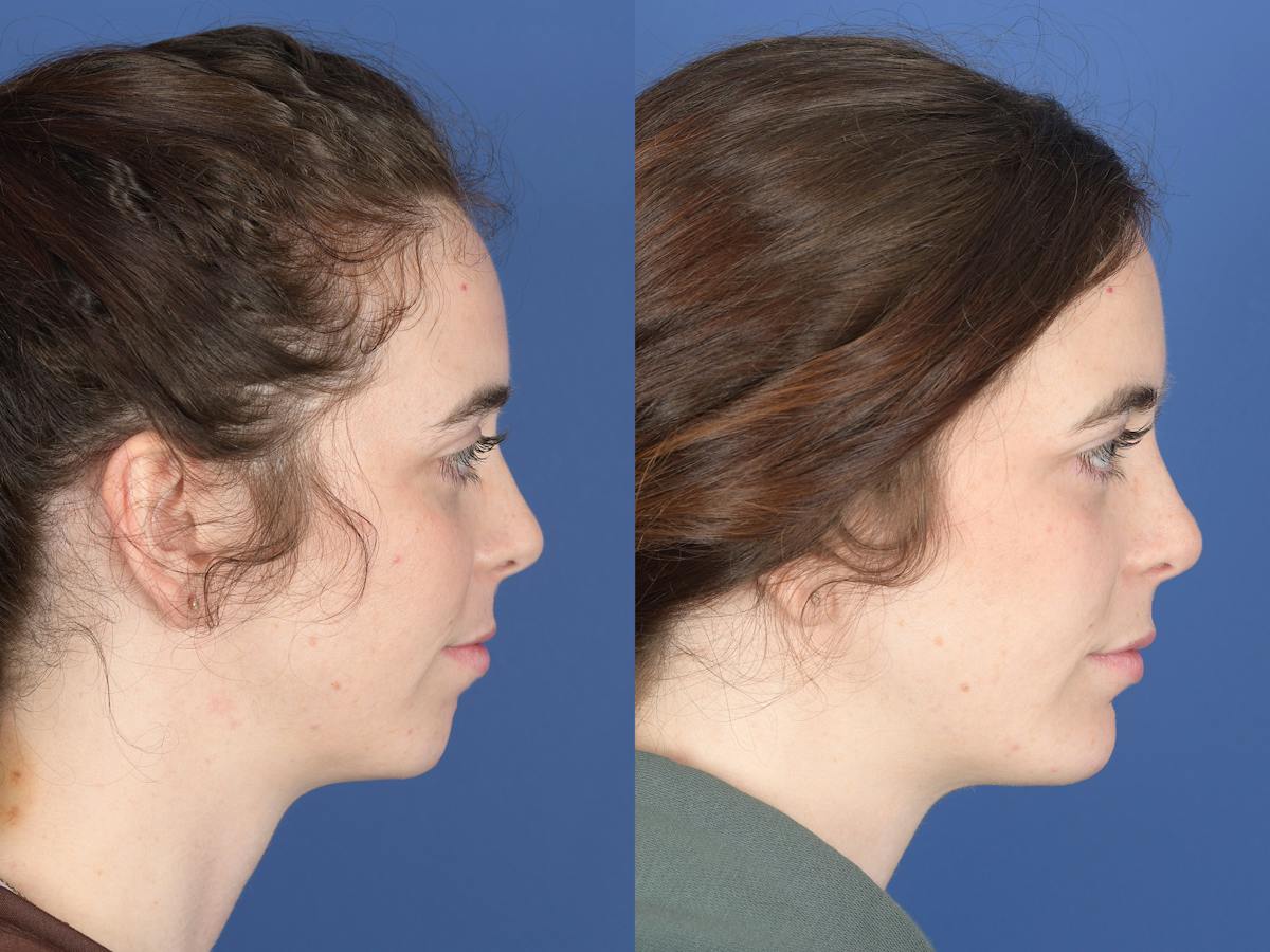 Chin Implant Before & After Gallery - Patient 399341 - Image 3
