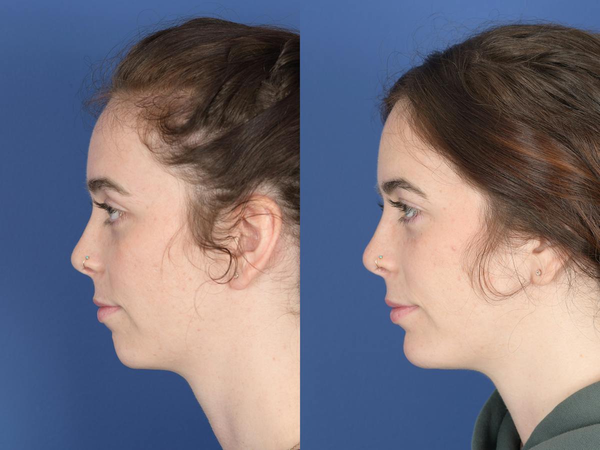 Chin Implant Before & After Gallery - Patient 399341 - Image 5