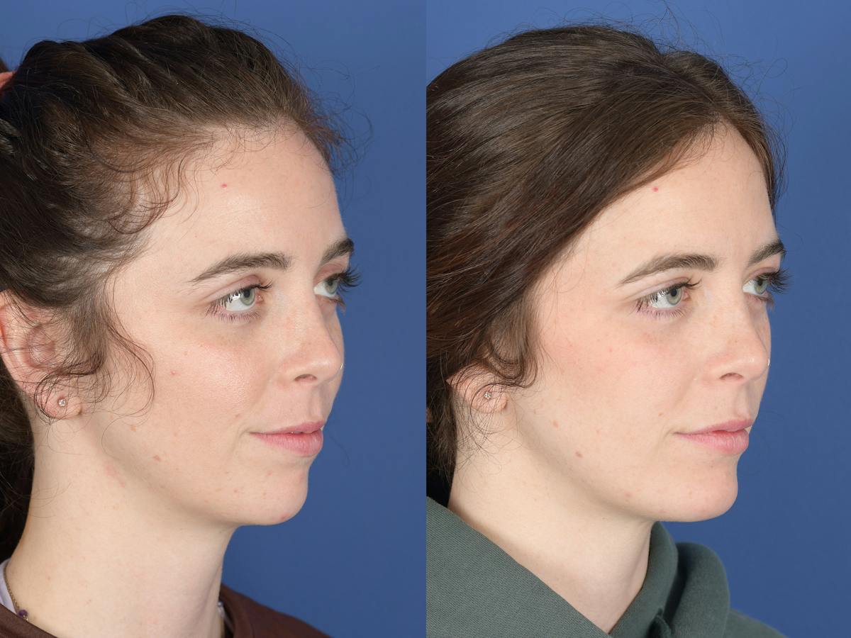 Chin Implant Before & After Gallery - Patient 399341 - Image 2