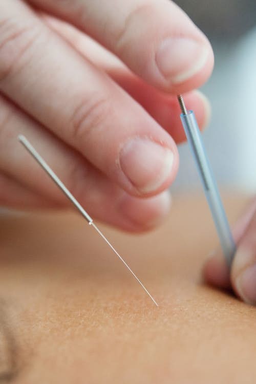 Acupuncture