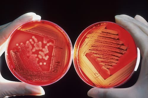 infection utérine cervicite endométrite myométrite