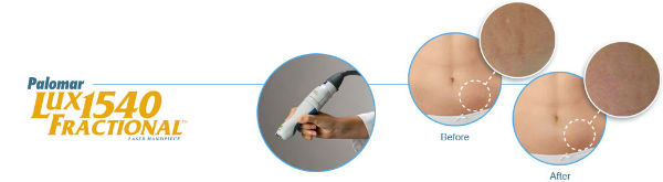 Palomar Lux Fractional Laser infograph