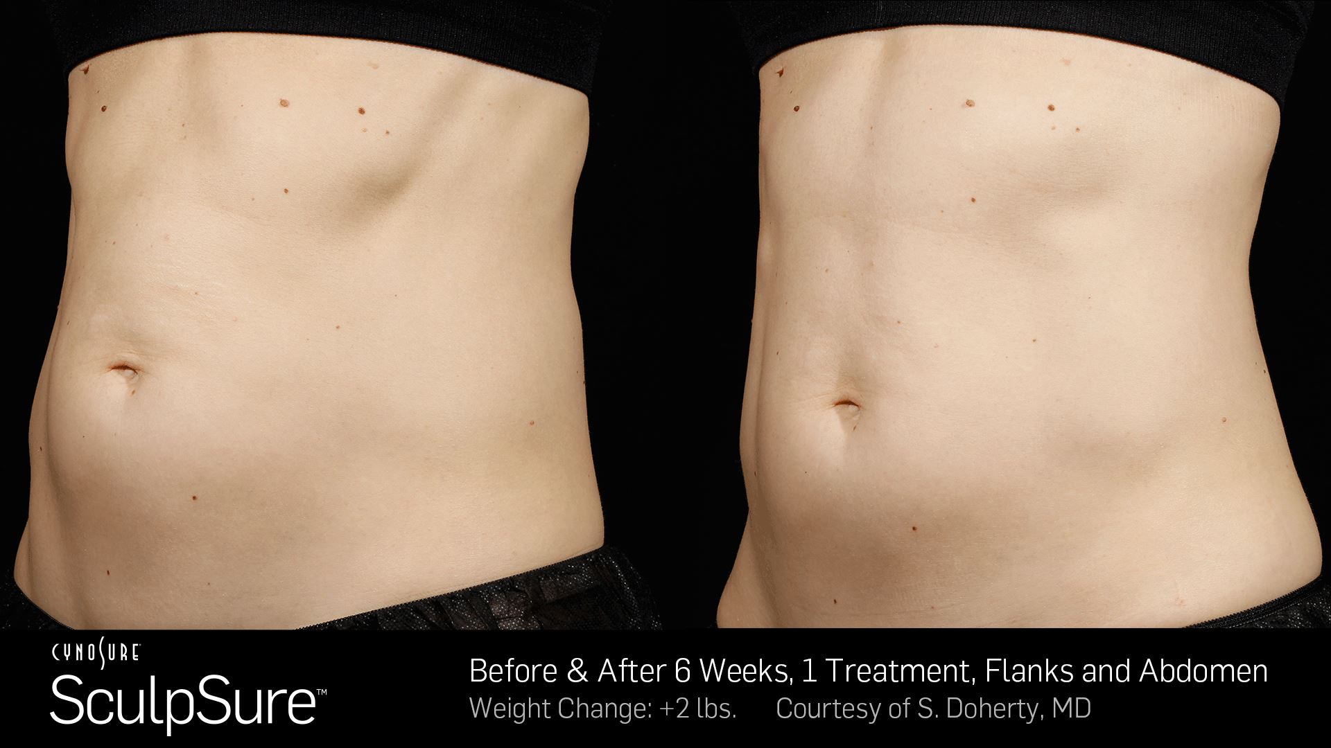 SculpSure 6 week before and after