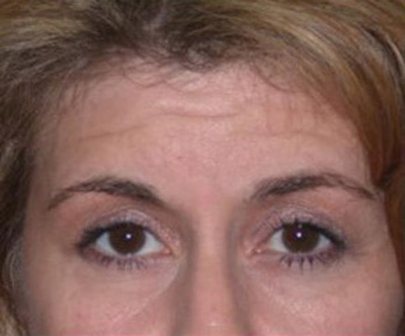 Non-Surgical Before & After Gallery - Patient 416492 - Image 1