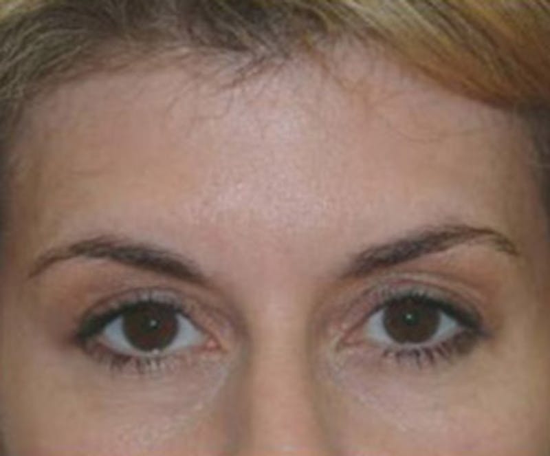 Non-Surgical Before & After Gallery - Patient 416492 - Image 2
