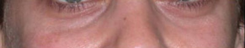 Non-Surgical Before & After Gallery - Patient 204731 - Image 1