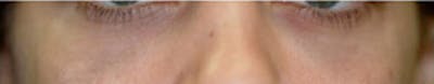 Non-Surgical Before & After Gallery - Patient 204731 - Image 2