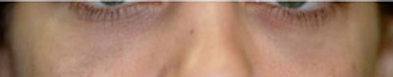 Non-Surgical Before & After Gallery - Patient 204731 - Image 2