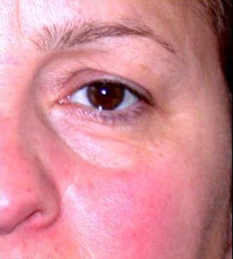 Non-Surgical Before & After Gallery - Patient 323882 - Image 1